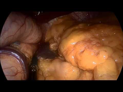 marSeal5 IQ – Sleeve gastrectomy