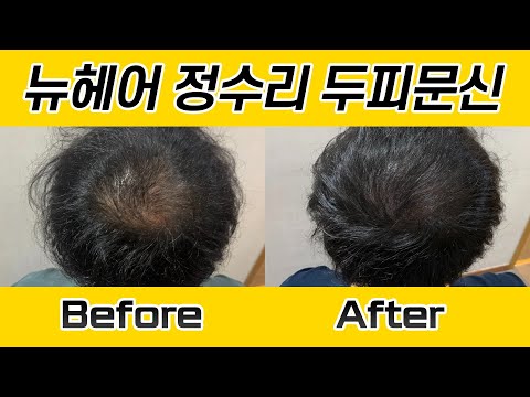 남자 두피문신 시술 전후 I 뉴헤어 SMP I 두피문신 I Before&After