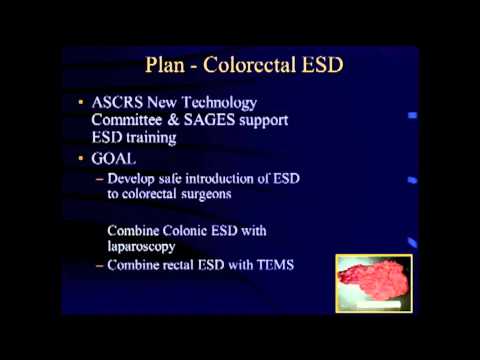 Dissection sous-muqueuse endoscopique avec laparoscopie diagnostique