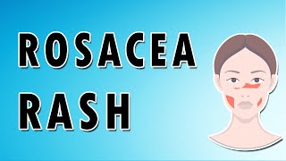 Rosacea Rash Symptoms, Treatment, and Causes