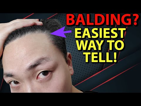 THE EASIEST WAY TO TELL IF YOU'RE GOING BALD AND LOSING HAIR IN UNDER 5 MINUTES!
