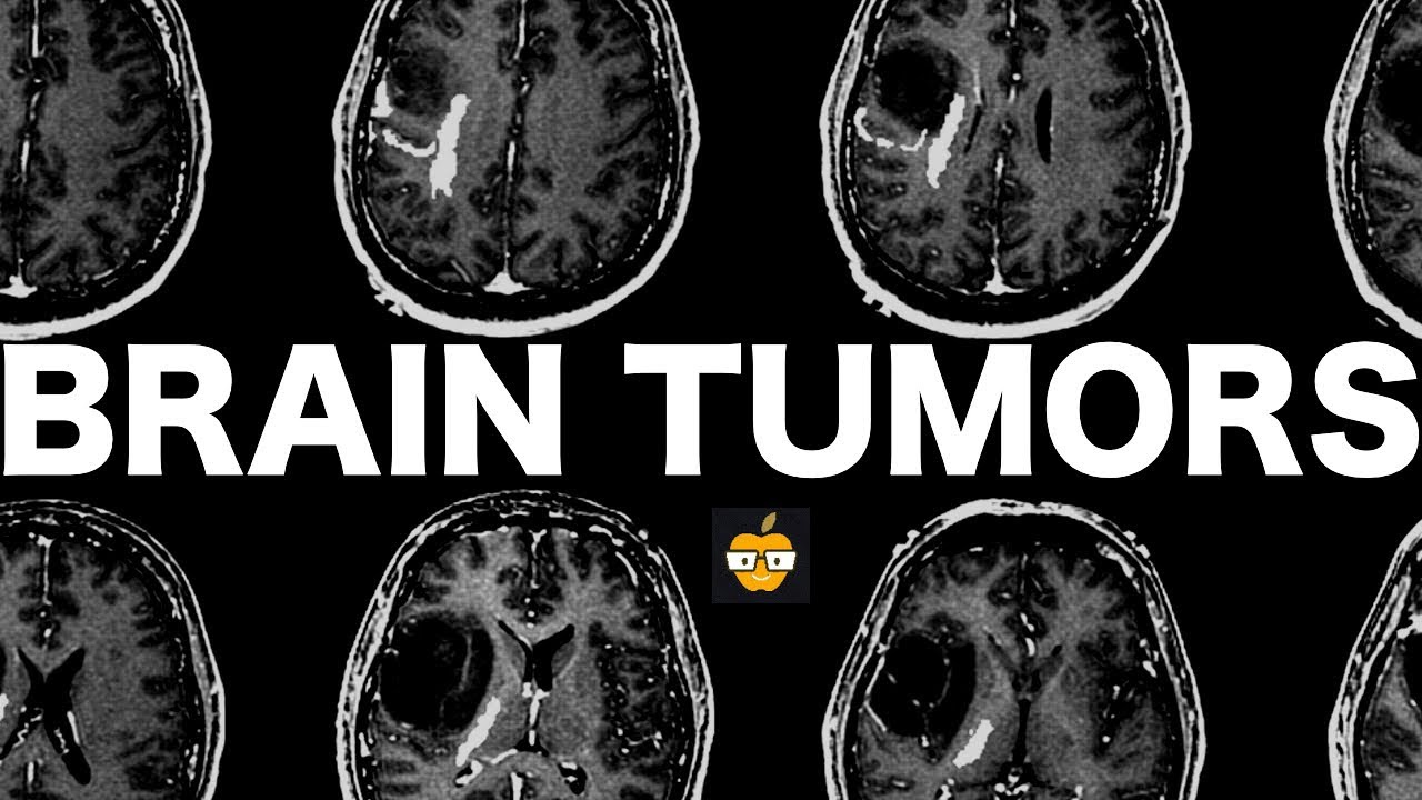 Brain Tumors