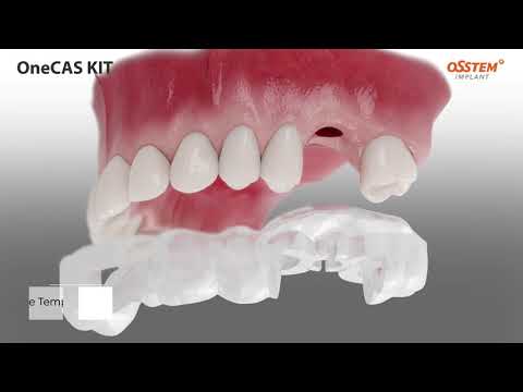 How It Works: OneCAS Kit - Crestal Approach Digital Guided Sinus Surgery System