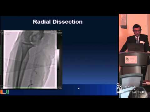 Anatomical Challenges: Spasms, Loops, Tortuosity by Mauricio G. Cohen, M.D.