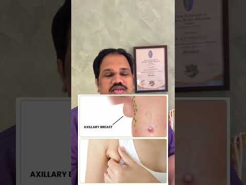 Axillary breast reduction video by Dr. Ram Prabhu.