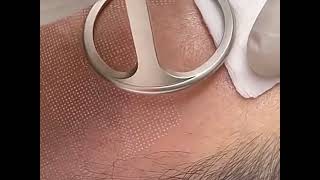 Fractional Co2 laser skincare rejuvenation treatment
