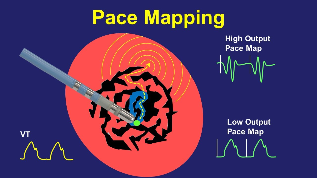 Pace Mapping:  Principles and Pitfalls