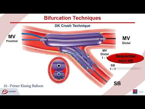 Bifurcations   DK Crush Technique  Step by step