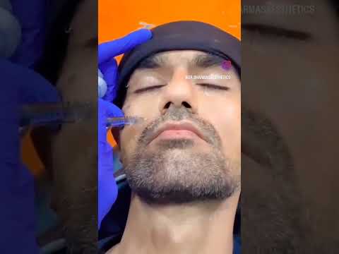 Filler Treatment nasolaial fold Treatment