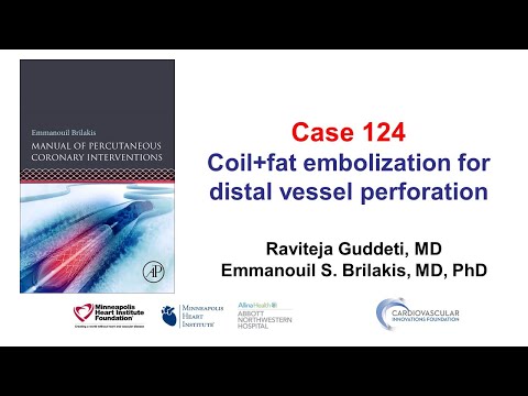 Case 124: PCI Manual - Combined coil and fat embolization for distal vessel perforation