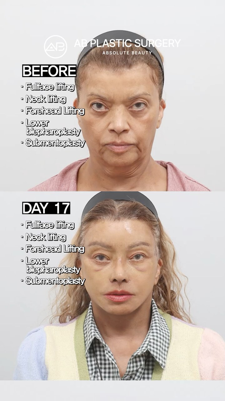 The Ultimate Lift: Face, Neck & Eyes