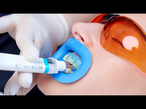 #howto fläsh In-Office Bleaching 03 von 08: Korrektes Auftragen des Bleachinggels