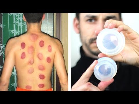What The Heck is Cupping? | Traditional Chinese Medicine Cupping Therapy