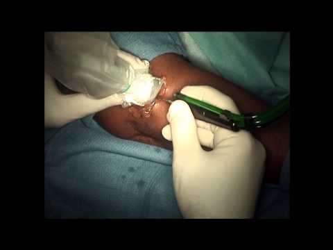 Tenex FAST Procedure Surgery for Lateral Elbow Tendionopathy - Fasciotomy & Surgical Tenotomy
