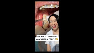 Download lagu MUST you extract your Wisdom Tooth? 🤔 Here's the answer! 🤗🌟🦷 #shorts mp3 Download lagu MUST you extract your Wisdom Tooth? 🤔 Here's the answer! 🤗🌟🦷 #shorts mp3