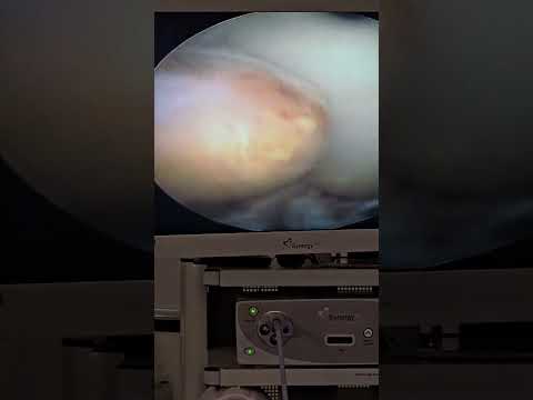 نجاح عمليةاستئصال ورم سينوفي في الركبة بالمنظار مع دكتور ابراهيم شعراوي