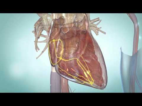 Premature Ventricular contraction (PVCs)