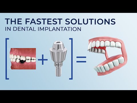 The fastest solutions in dental implantation. New technologies in the dental industry. Healing &time