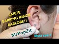 Giant earring completely hidden inside earlobe.Foreign body pop,Metal extraction.Must see to believe