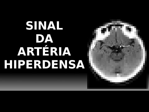 TC de Crânio - Sinal da artéria hiperdensa