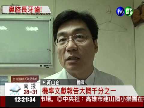 老是流鼻血?!鼻子裡竟長2公分牙