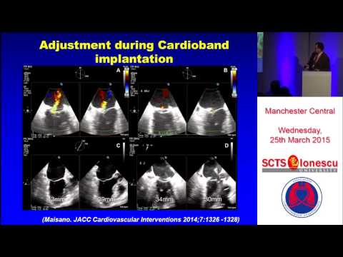 Trans-Catheter Mitral Valve Repair: An Overview