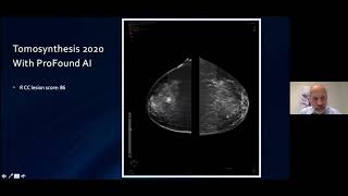 Dr. Axel Gru00e4wingholt | ProFound AI and ProFound AI Risk Clinical Case Study
