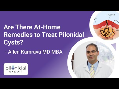 Are There At-Home Remedies to Treat Pilonidal Cysts? Ask the Pilonidal Expert