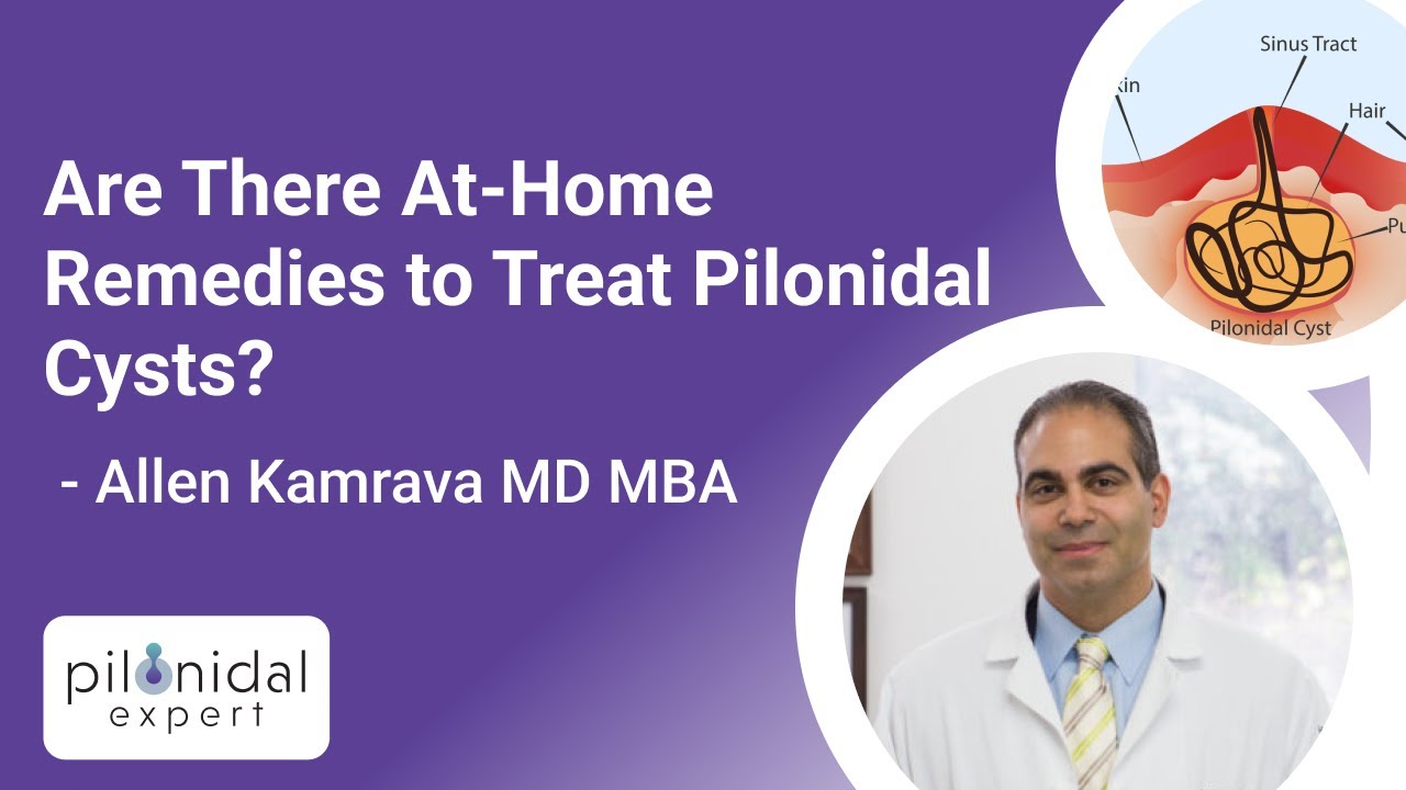 Are There At-Home Remedies to Treat Pilonidal Cysts? Ask the Pilonidal Expert