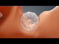 Left Atrial Appendage Closure Feat Dr Almany