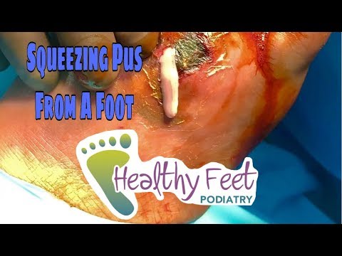 Squeezing pus out of a foot