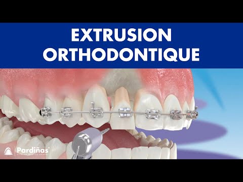 Extrusion orthodontique ©