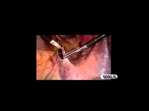 Laparoscopic Sacrocolpopexy for Vaginal Vault Prolapse