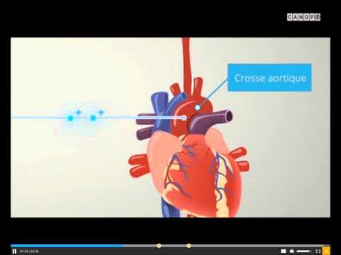 Causes de crise hypertensive Comment faire une teinture de Viburnum dhypertension