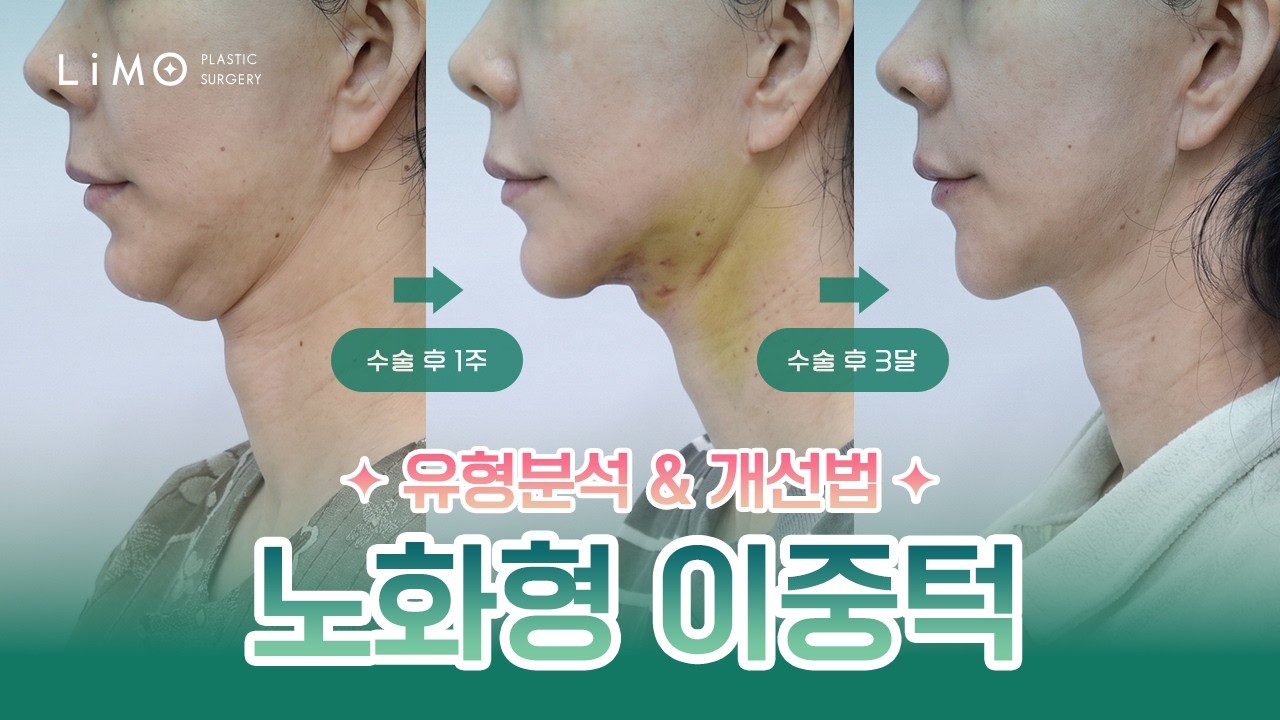 위고비 마운자로 안면거상 영상 리모성형외과