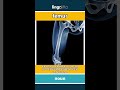 femur (noun) - definition and usage in English