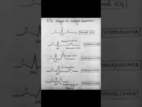 ECG changes