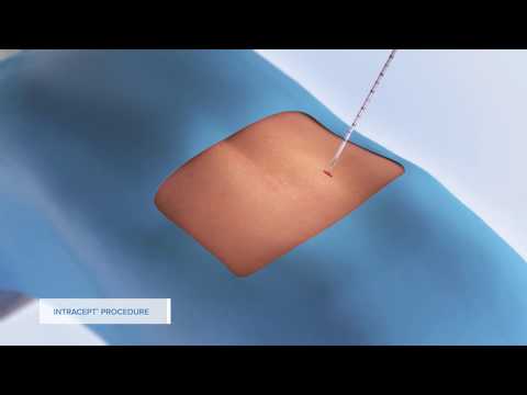 Intracept Procedure- Spine Team Texas