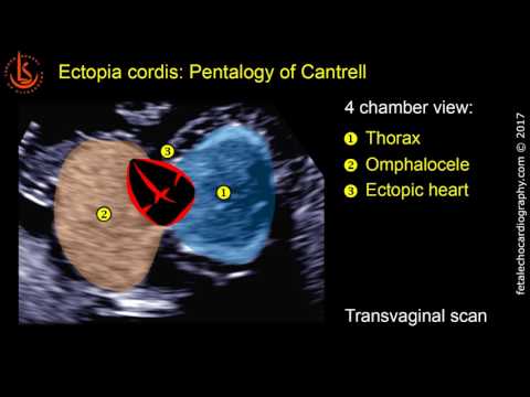 Badanie ultrasonograficzne serca 11-13 tygodniowego płodu: Ektopia serca płodu, Pentalogia Cantrella