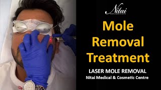 Download lagu Laser Mole Removal | Face Mole Removal Treatment | Nitai Cosmetics Melbourne mp3
