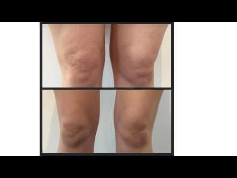 Koślawe zniekształcenie Tula Hammer toe deformacja