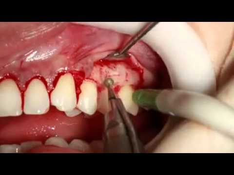 Cirurgia plástica periodontal: Estética e harmonia do sorriso