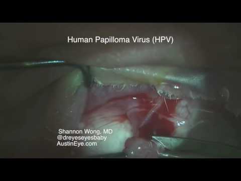 Papillomavirus glandes salivaires