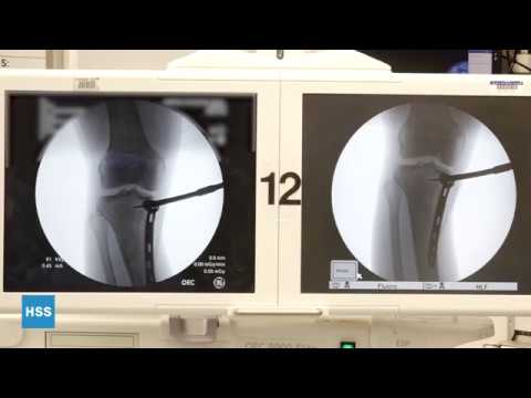 Image - High Tibial Osteotomy Live Surgery