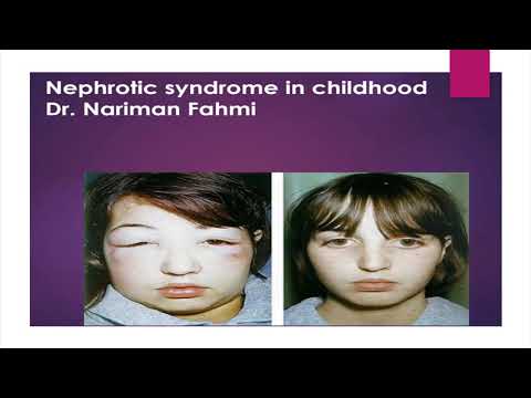 Ped Lec 19 Nephrotic Syndrome in Children by Prof  Nariman Fahmi