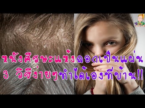 วางโดดเด่นโรคสะเก็ดเงิน ปลาหมึกในโรคสะเก็ดเงินสามารถ
