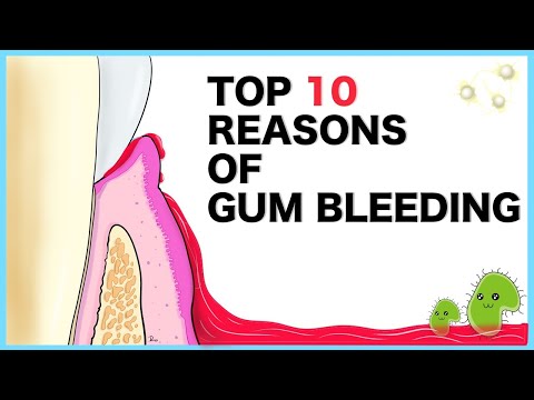 Gum Bleeding: Top 10 causes
