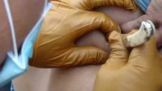 preview picture of video 'Extreme Gross Cyst operation'