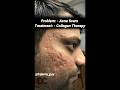 Successful Treatment Of Acne Scars Acne Scars Openporesremedy Boxerscars Scarstreatment Skin