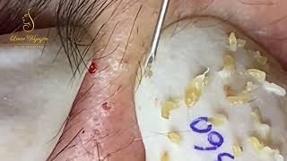 Loan Nguyen Acne Treatment 360pre